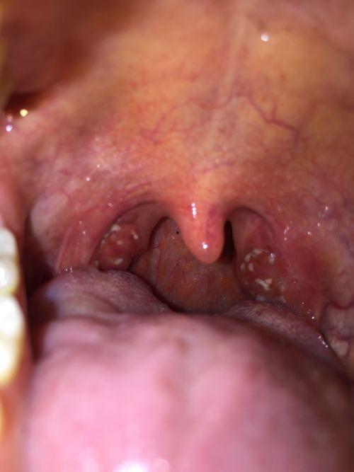 吃烧瓜嗓子发炎,揭秘嗓子发炎的饮食隐患