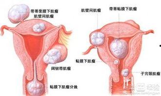 子宫肌瘤吃瓜拉纳,子宫肌瘤患者如何通过瓜拉纳辅助调理
